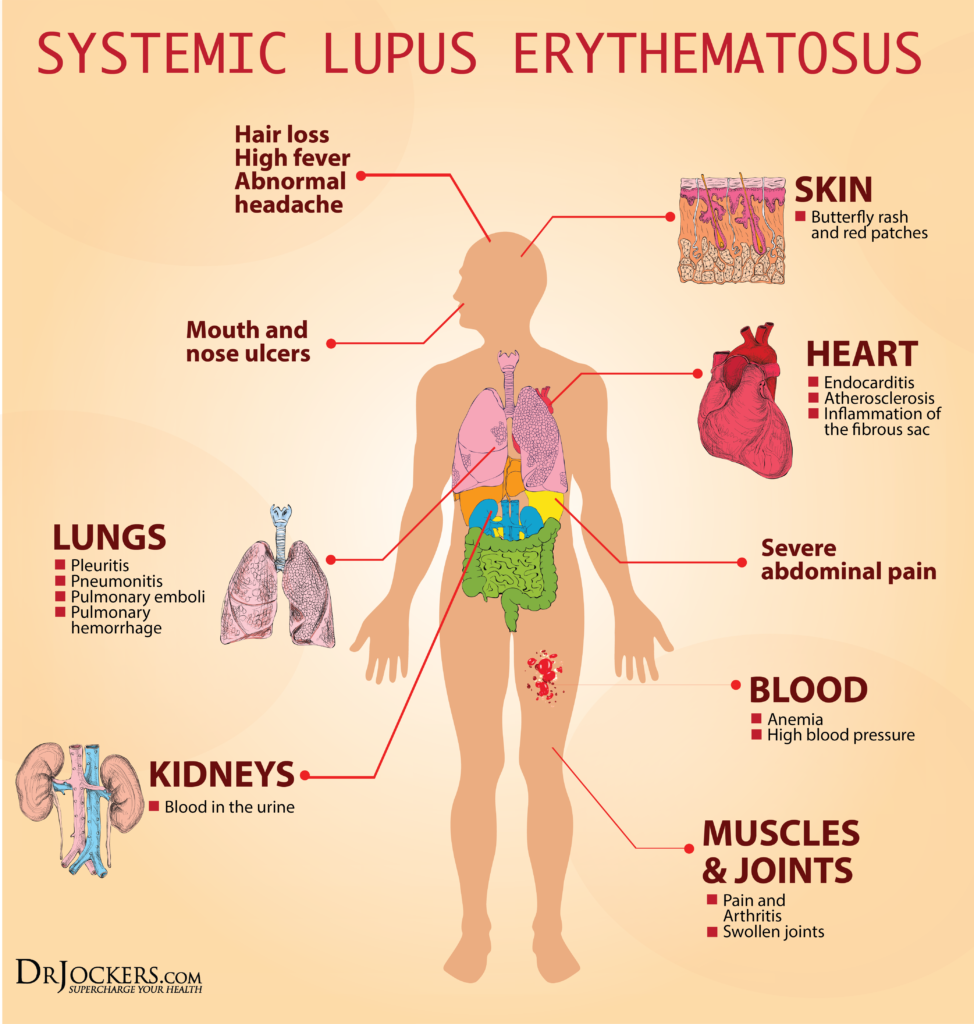 19 Ways To Heal Systemic Lupus Naturally DrJockers