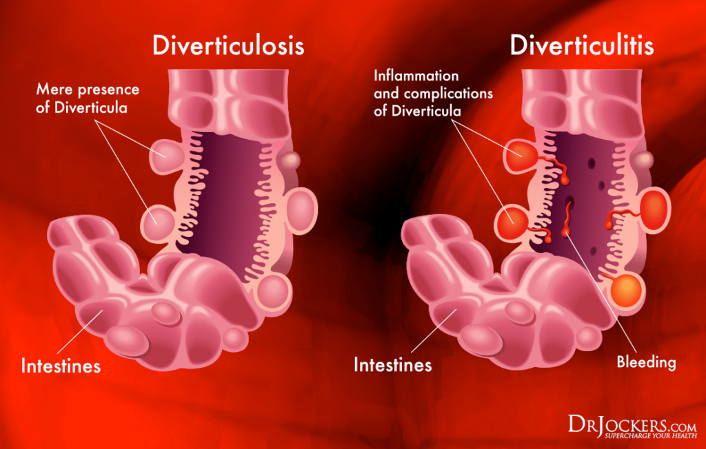 Diverticulitis Causes Symptoms Natural Support Strategies