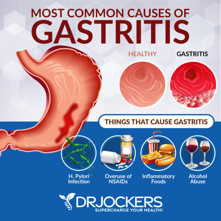 Gastritis Symptoms Causes And Support Strategies Drjockers