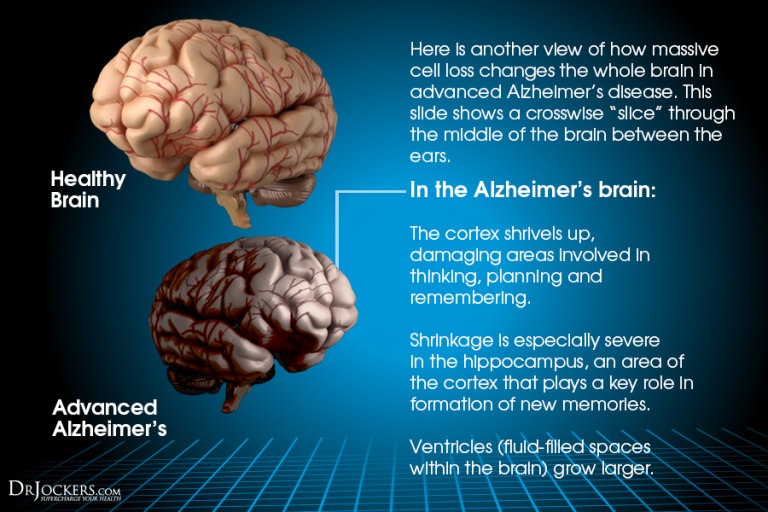 Are You Causing Brain Inflammation With Your Lifestyle?