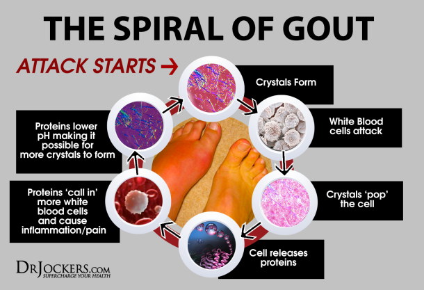 Gout: Symptoms, Causes and Natural Support Strategies