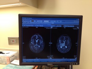 Brain Tumor, Brain Tumor Healed