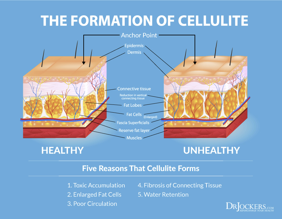 Cellulite, Top 10 Strategies to Get Rid of Cellulite Naturally