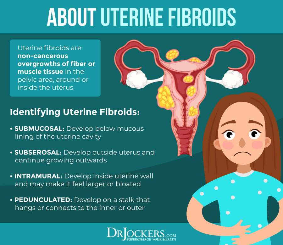 Uterine Fibroids Symptoms Causes Complications And 56 OFF