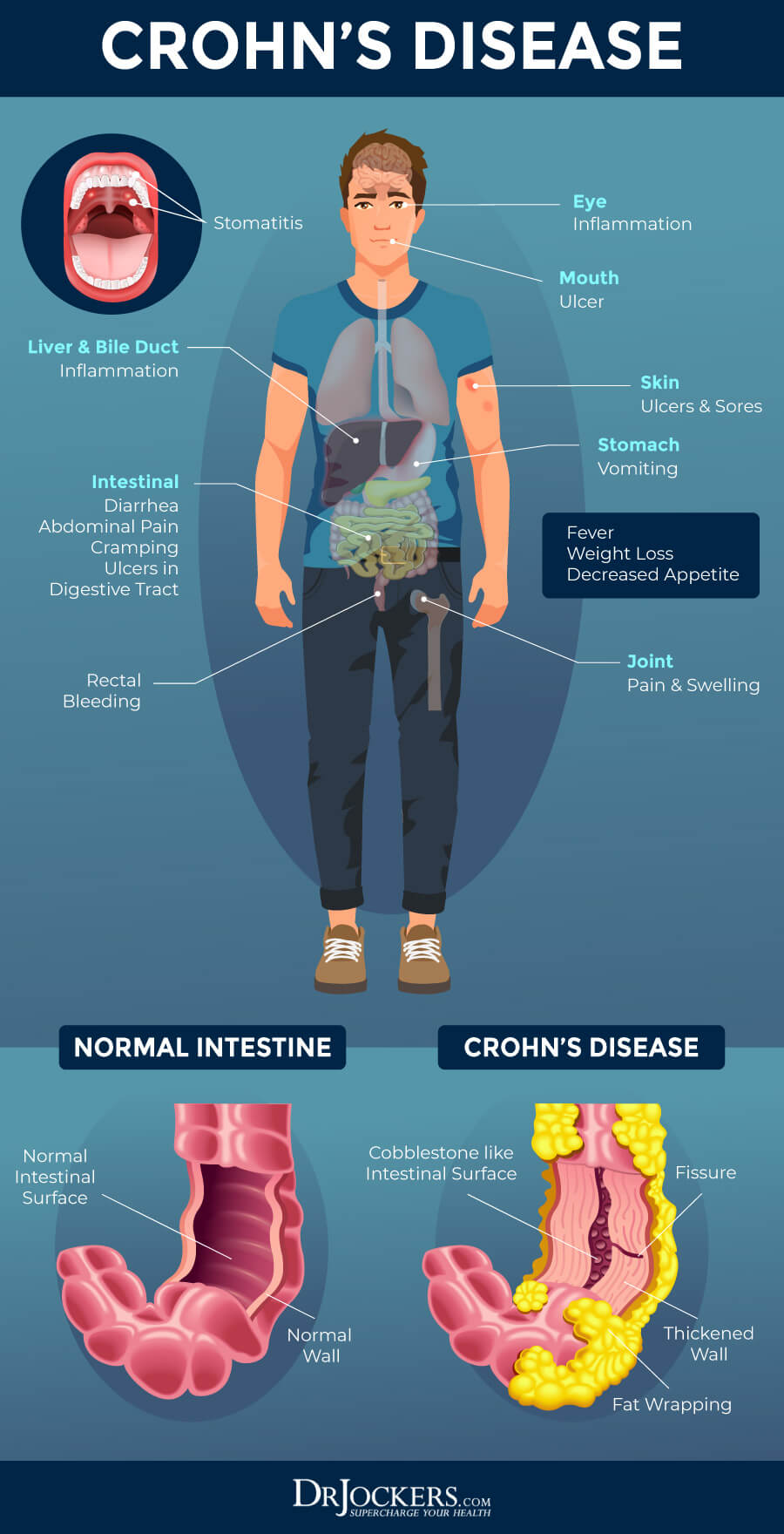Crohn s Disease Symptoms Causes And Support Strategies