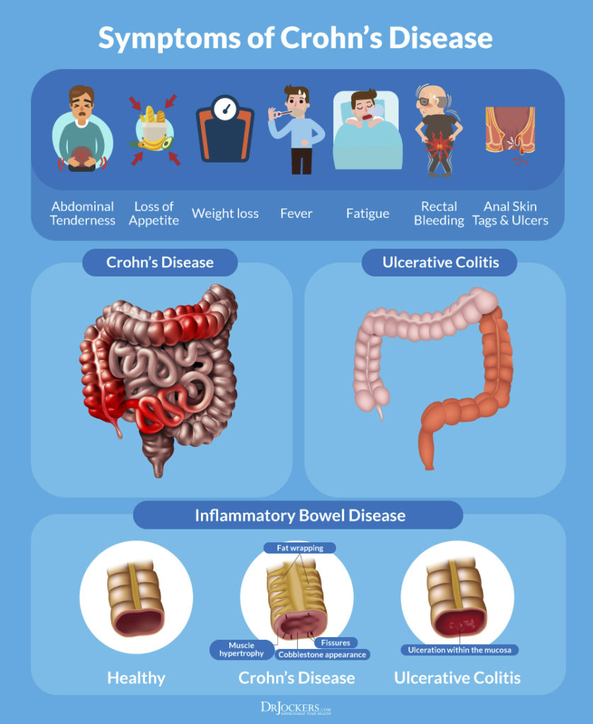 Crohn's Disease, Crohn’s Disease: Symptoms, Causes and Natural Support Strategies