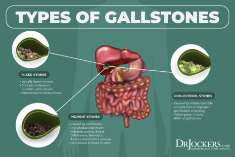 How to Beat GallStones Naturally - DrJockers.com