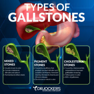 How to Beat GallStones Naturally - DrJockers.com