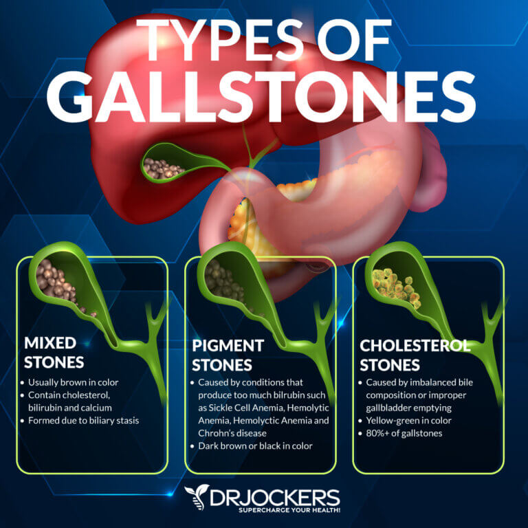 How to Beat GallStones Naturally - DrJockers.com