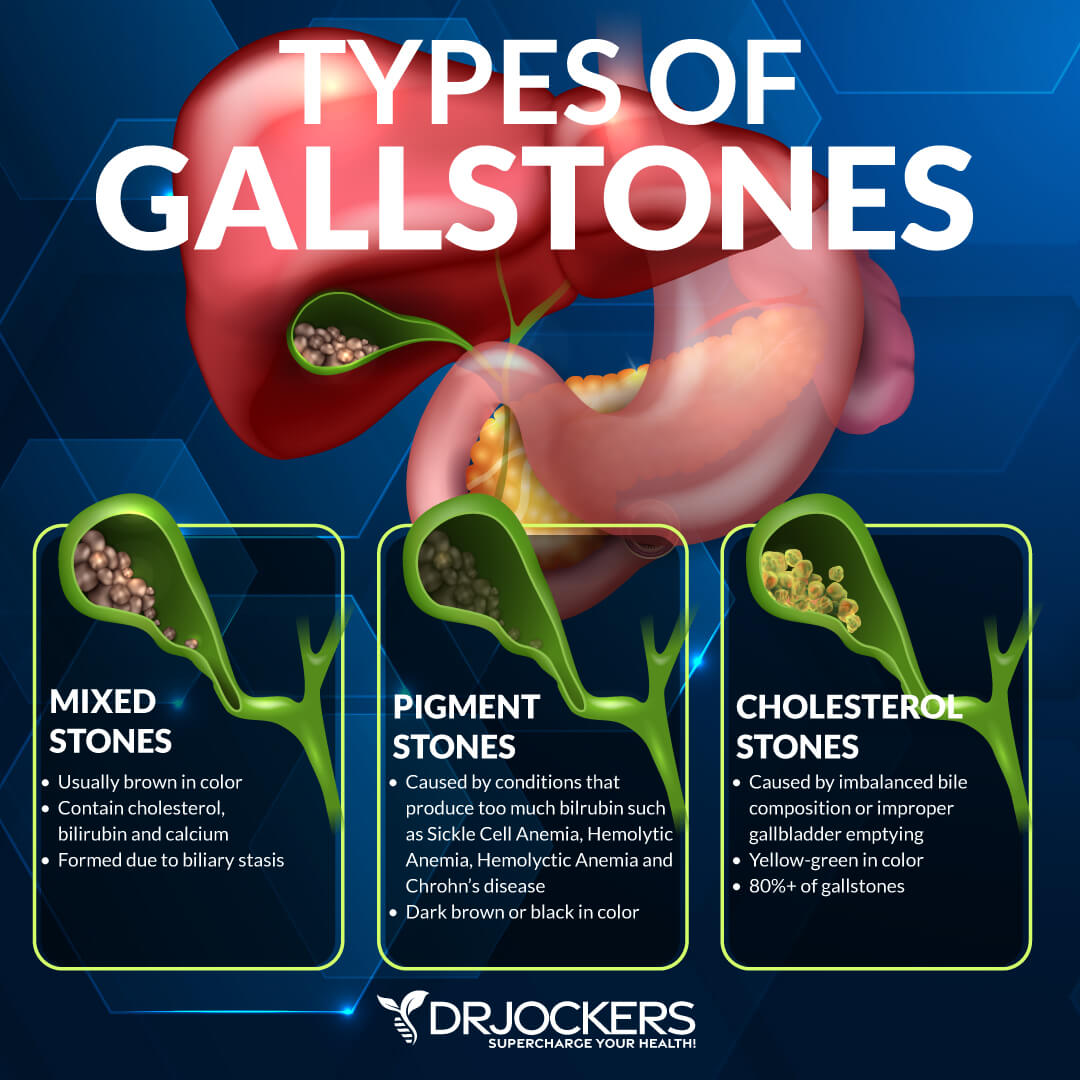 gallstones