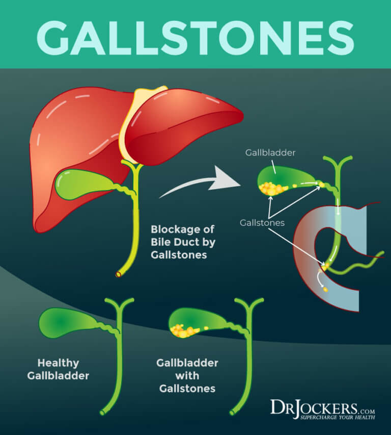 How to Beat GallStones Naturally - DrJockers.com