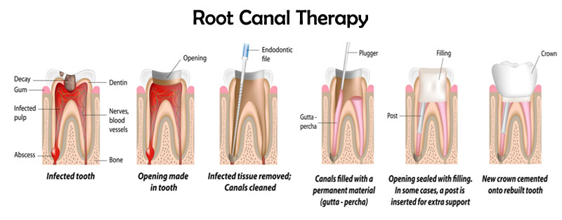 root canals, The Dangers of Root Canals