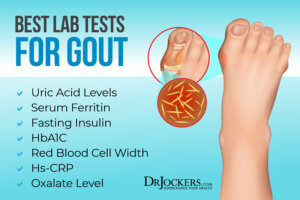 Gout: Symptoms, Causes and Natural Support Strategies