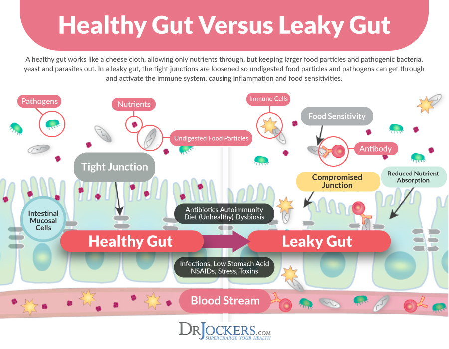 heal leaky gut, 6 Nutrients That Heal Leaky Gut Syndrome