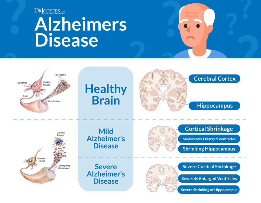 Alzheimer's Disease, Alzheimer&#8217;s Disease: Symptoms, Causes and Natural Support Strategies
