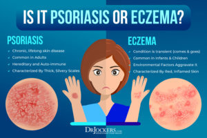 Eczema: Symptoms, Causes & Support Strategies - DrJockers.com