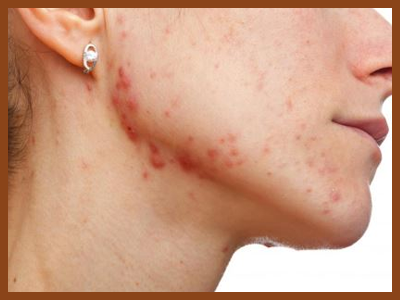 acne, 10 Things Acne Means About Your Health