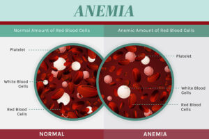 Anemia: Causes, Symptoms and Support Strategies - DrJockers.com