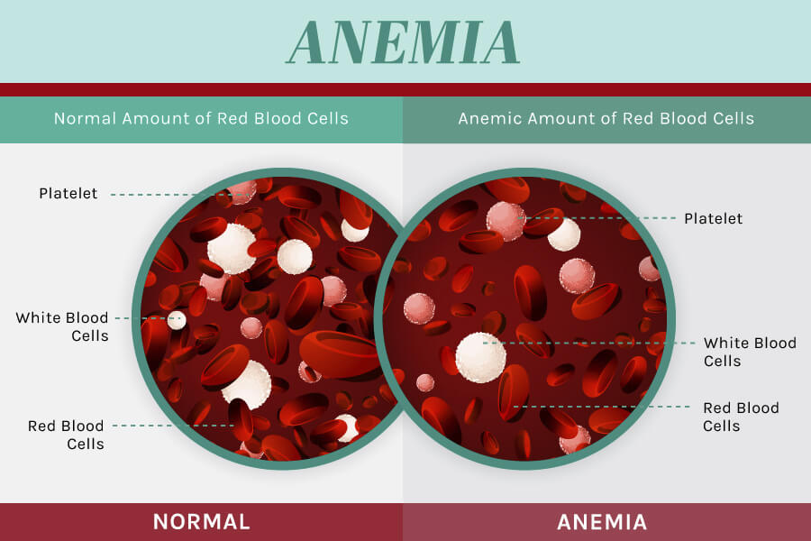 Anemia Causes Symptoms And Support Strategies 7519