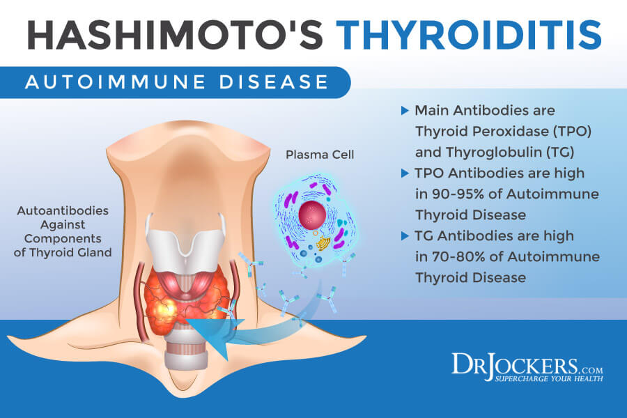 Hashimoto's, Hashimoto&#8217;s Thyroiditis:  Causes, Symptoms and Support Strategies