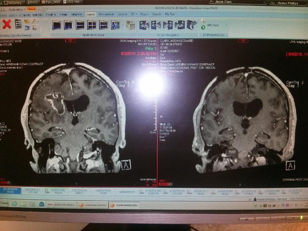 brain tumor healing, Brain Tumor Healing Naturally