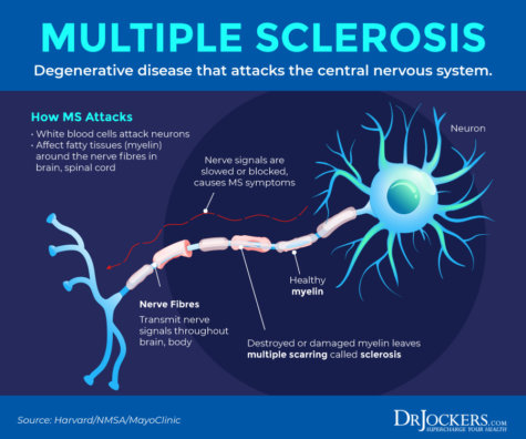 Multiple Sclerosis: Causes, Symptoms & Natural Support Strategies