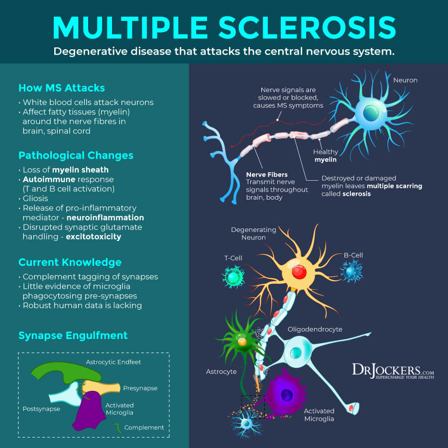 multiple sclerosis, Multiple Sclerosis:  Causes, Symptoms &#038; Natural Support Strategies