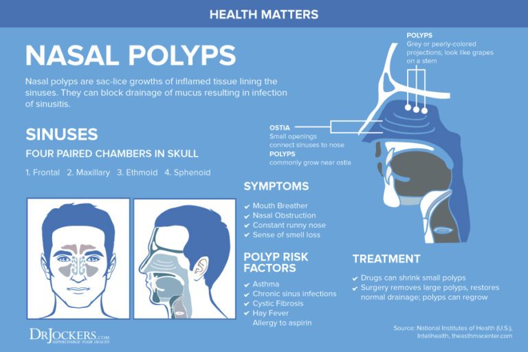 Nasal Polyps: Symptoms, Causes and Natural Support Strategies