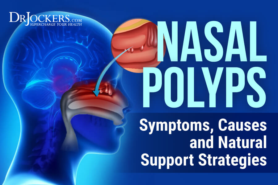 Nasal Polyps, Nasal Polyps:  Symptoms, Causes and Natural Support Strategies