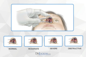 Nasal Polyps: Symptoms, Causes and Natural Support Strategies