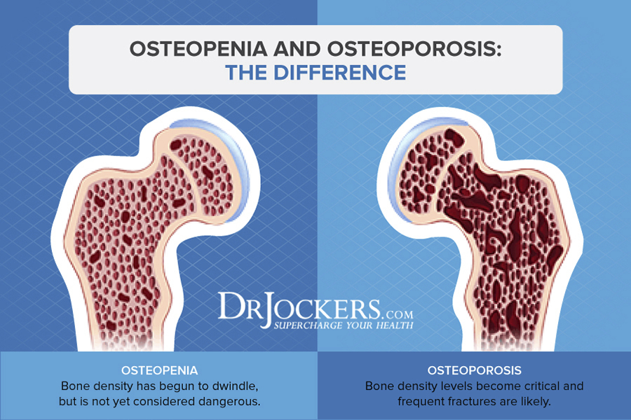 Osteoporosis, Osteoporosis: Symptoms, Causes and Natural Support Strategies