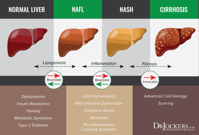 Fatty Liver: Symptoms, Causes and Natural Support Strategies