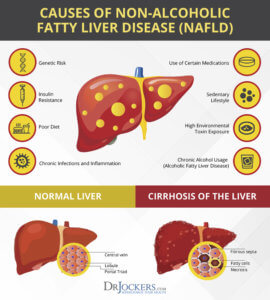 Fatty Liver: Symptoms, Causes and Natural Support Strategies