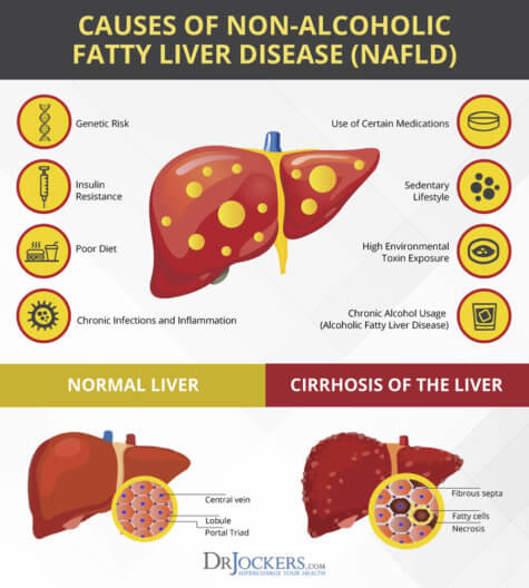 Fatty Liver Symptoms Causes And Natural Support Strategies