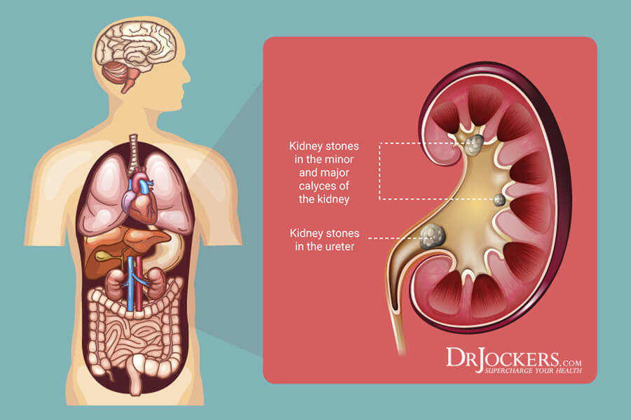 kidney stones, Kidney Stones: Symptoms, Causes and Support Strategies