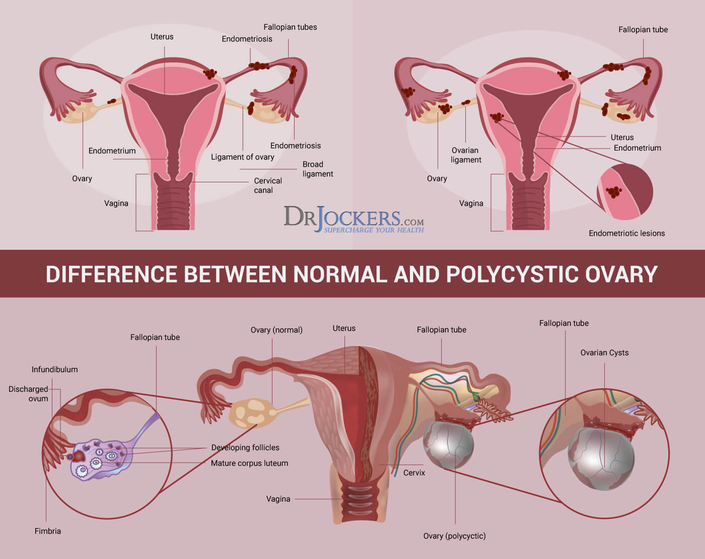 PCOS, PCOS:  Symptoms, Causes and Support Strategies