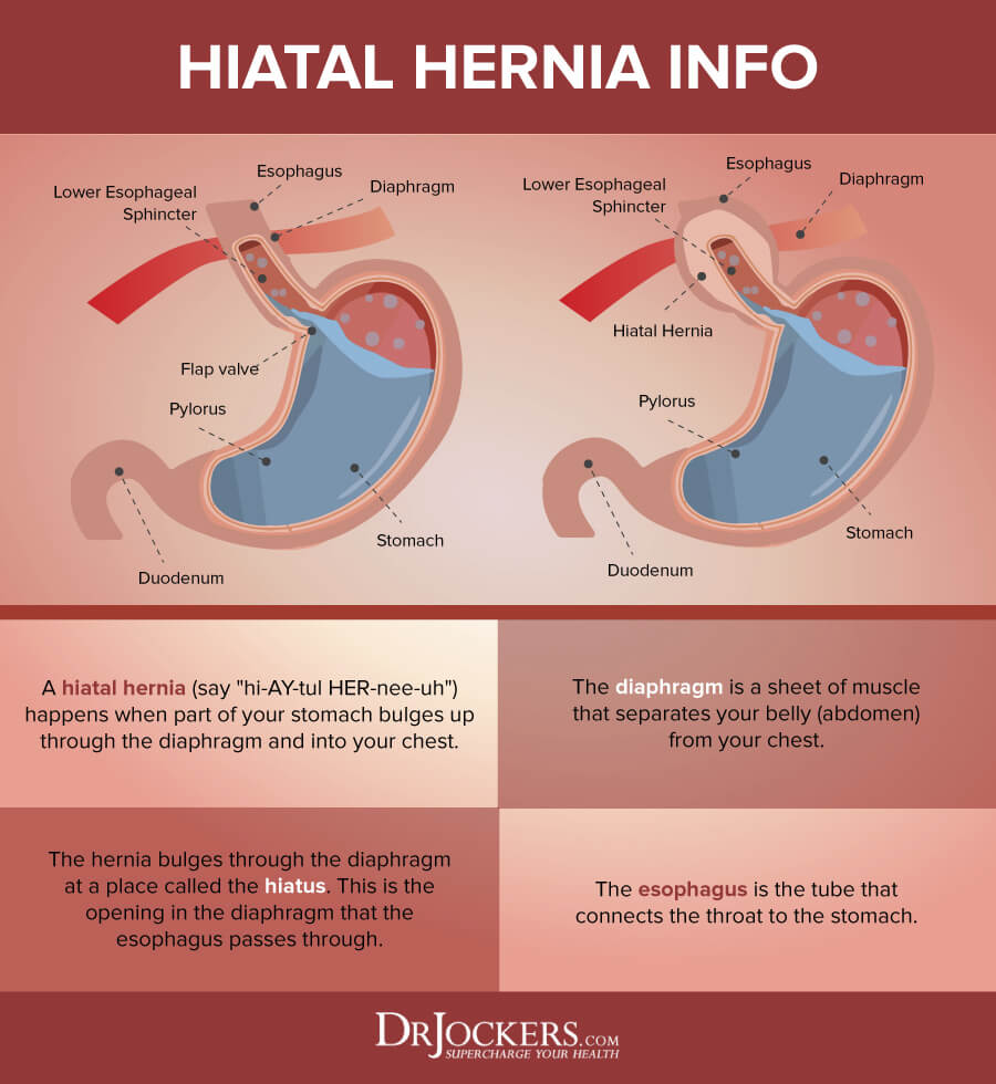 hiatal hernia, Hiatal Hernia: What it is and Natural Treatments