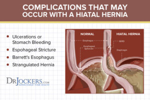 Hiatal Hernia: Symptoms, Causes and Natural Support Strategies