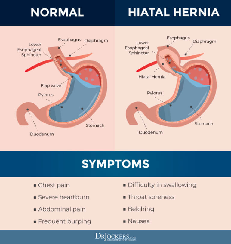 Hiatal Hernia Symptoms Causes And Natural Support Strategies