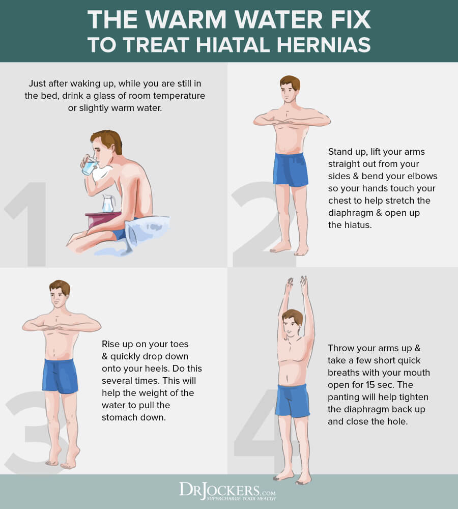 hiatal hernia, Hiatal Hernia: Symptoms, Causes &#038; Natural Support Strategies