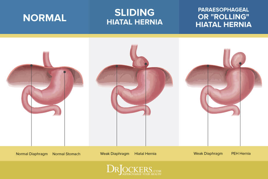 hiatus-hernia-hiatal-hernia-types-of-hiatal-hernia-illustration-stock