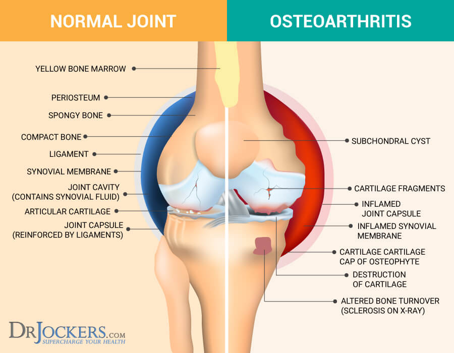 osteoarthritis, Osteoarthritis: Symptoms, Causes &#038; Natural Support Strategies