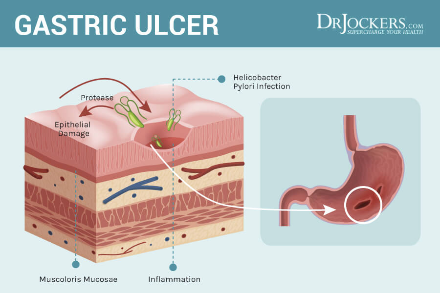stomach ulcers, Stomach Ulcers: Causes and Natural Support Strategies