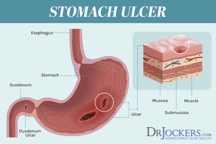 Stomach Ulcers Causes And Natural Support Strategies 