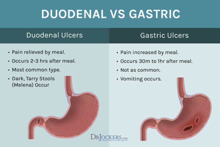 Stomach Ulcers Causes And Natural Support Strategies 