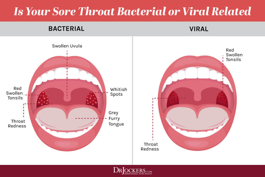 Strep Throat Symptoms and 15 Natural Support Strategies