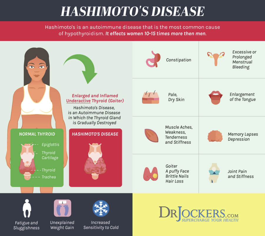 Hashimoto's, Hashimoto&#8217;s Thyroiditis: Causes, Symptoms and Support Strategies