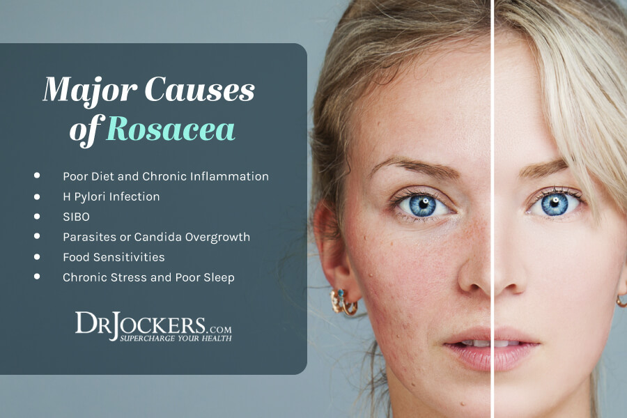 rosacea, Rosacea:  Causes and Natural Support Strategies