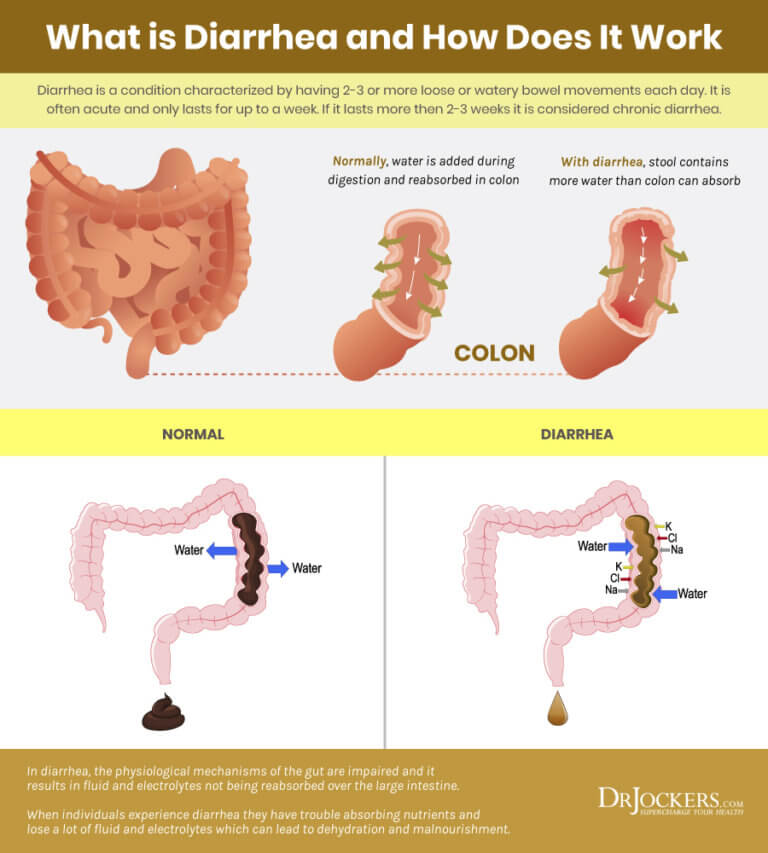 Diarrhea: Major Causes and How to Get Rid of It - DrJockers.com