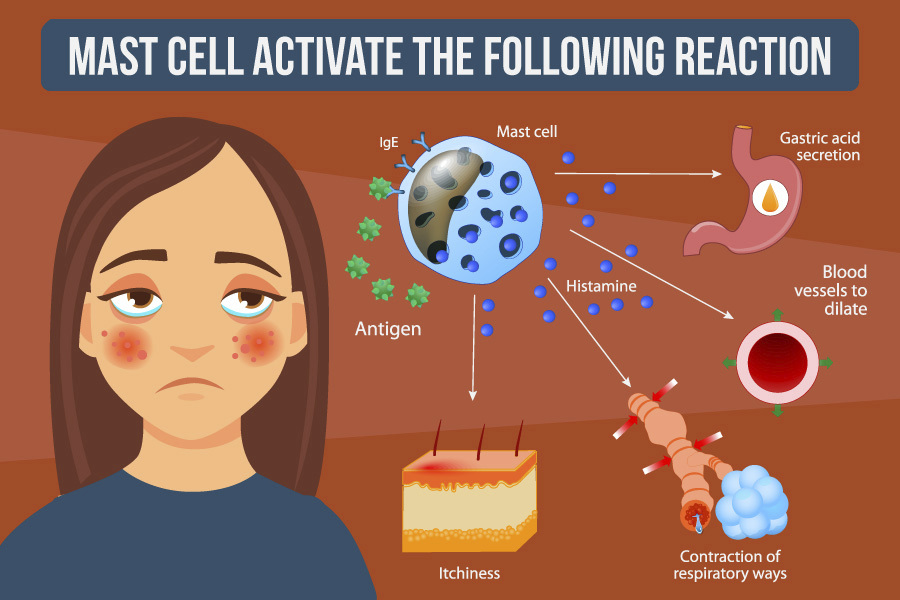 Mast Cell, Mast Cell Activation Syndrome:  Symptoms and Solutions